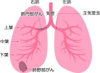肺がんアイコン（…