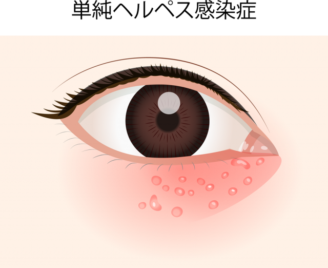 目の病気イラスト Csai Png 無料イラスト素材 素材ラボ