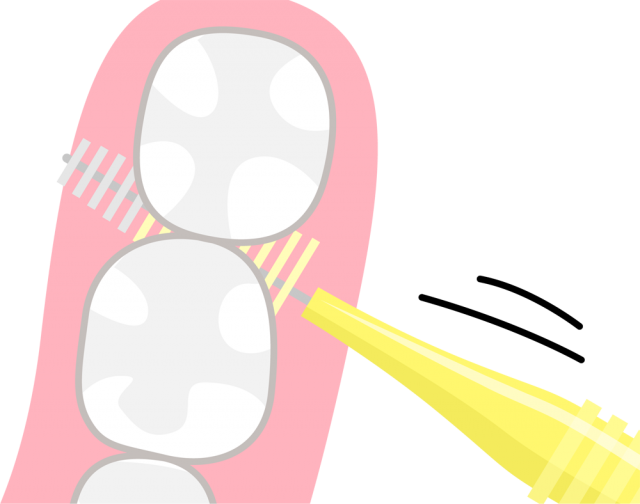 歯間ブラシの使い方イラスト Csai Png 無料イラスト素材 素材ラボ