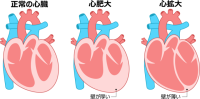 心臓・心肥大・心…