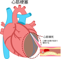 心臓・心筋梗塞ア…