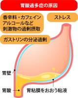 胃酸過多症の原因…