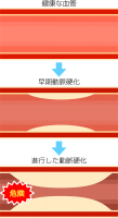 動脈硬化アイコン…