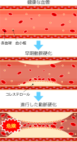 動脈硬化アイコン…