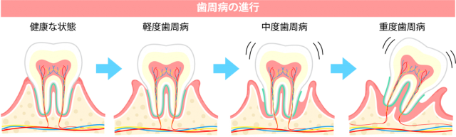 歯周病進行イラスト Csai Png 無料イラスト素材 素材ラボ