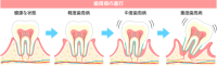 歯周病進行イラス…