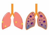 健康な肺と病気の…