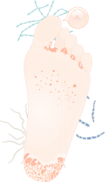 水虫の足（CSa…