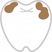 虫歯の歯01