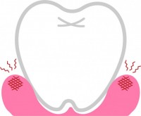 歯茎の腫れ01