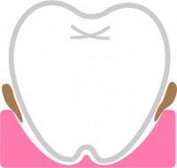 歯茎の汚れ01